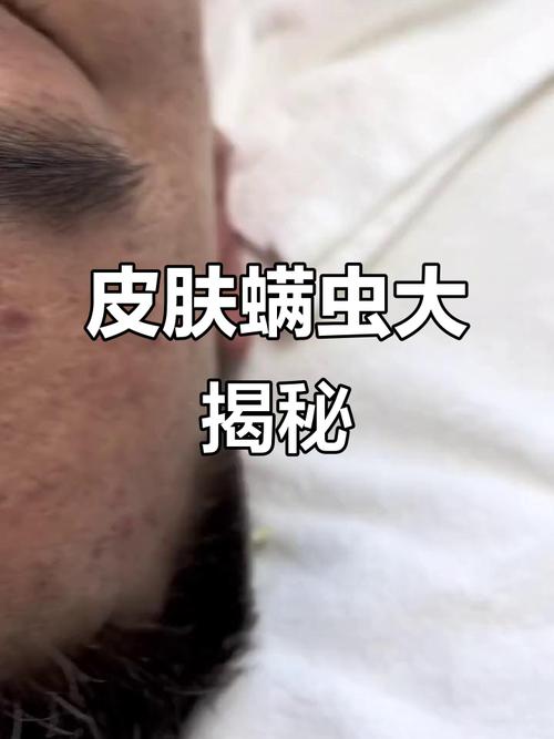 有螨虫的皮肤图片有哪些典型特征?