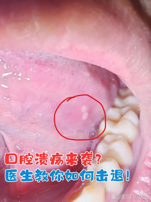 口腔起白泡是啥原因?