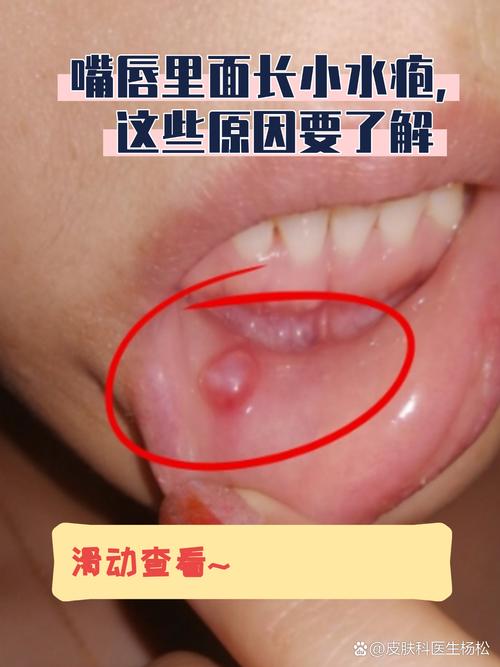 口腔起白泡是啥原因?