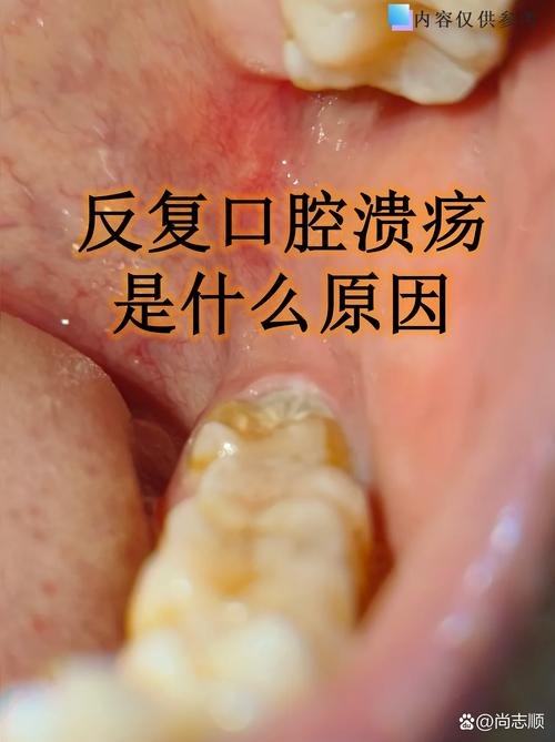 为何口腔溃疡总在同一处反复发作?