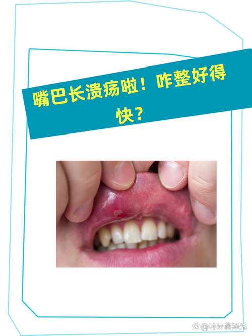 口腔溃疡频发,究竟为何?