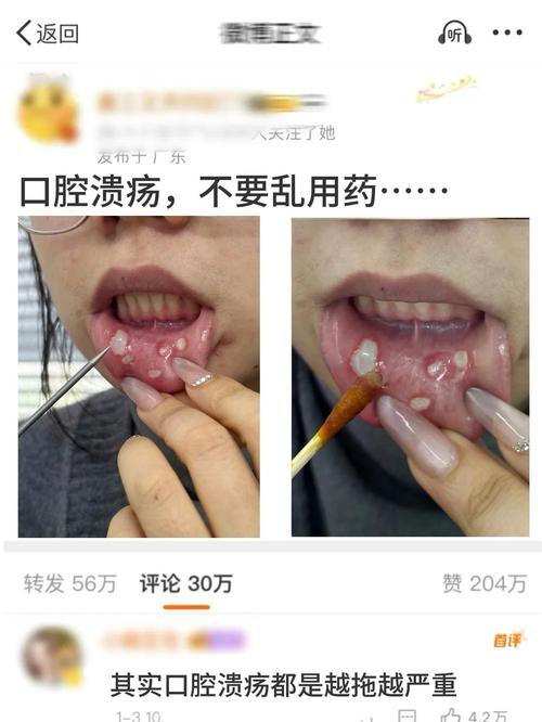 口腔反复溃烂是缺营养还是免疫力差?