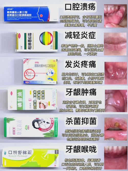 口腔溃疡反复发作该挂什么科?