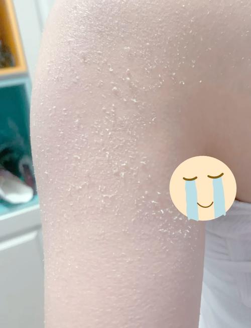 皮肤一块块粗糙干皮是啥原因?