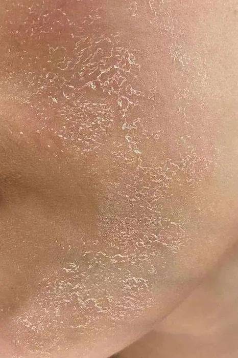 皮肤一块块粗糙干皮是啥原因?