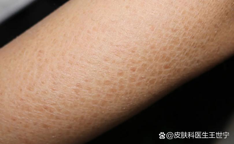 皮肤一块块粗糙干皮是啥原因?