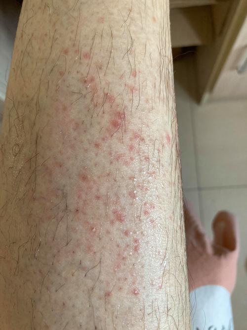 皮肤痒一挠起红点红块是过敏还是什么问题?