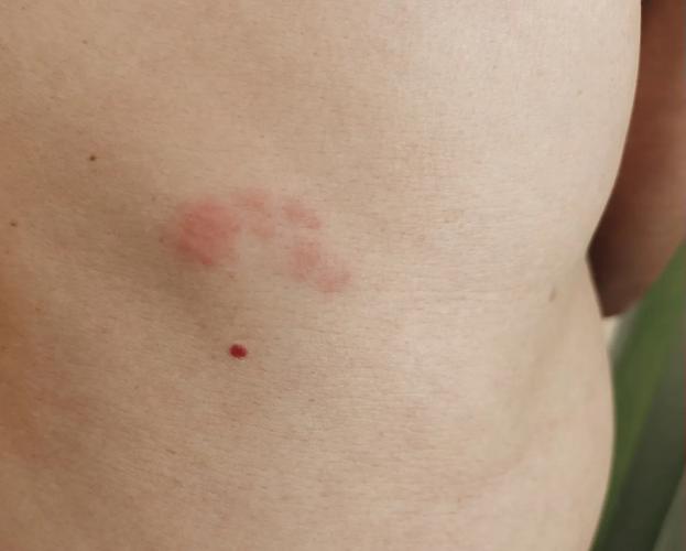 皮肤痒一挠起红点红块是过敏还是什么问题?