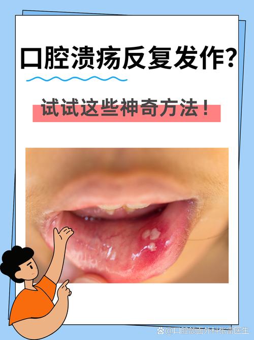 口腔溃疡该挂内科还是口腔科?