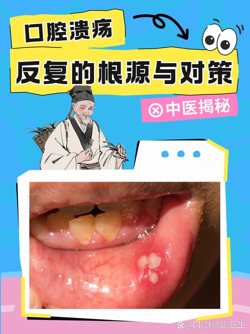 口腔溃疡该挂内科还是口腔科?