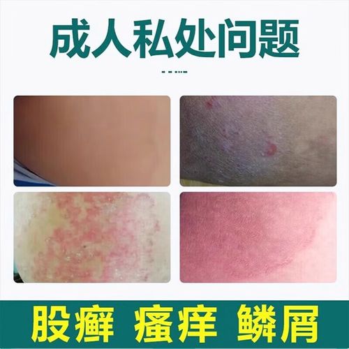 大腿内侧瘙痒,该用啥药?