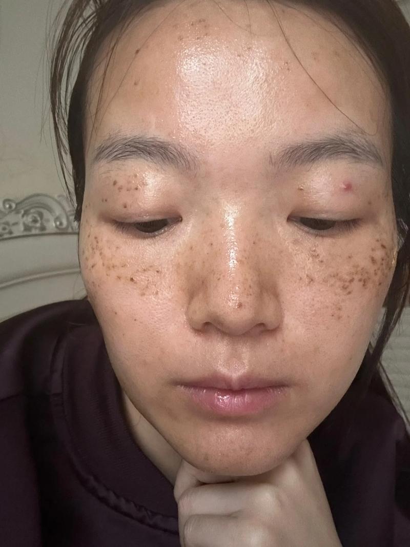 激光祛斑后多久皮肤能恢复正常?