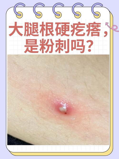 皮肤下不痛不痒的硬疙瘩是何问题?