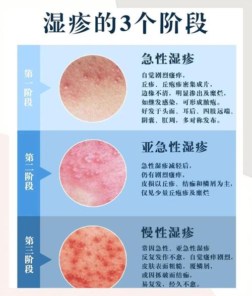 皮肤湿疹是什么原因引起的