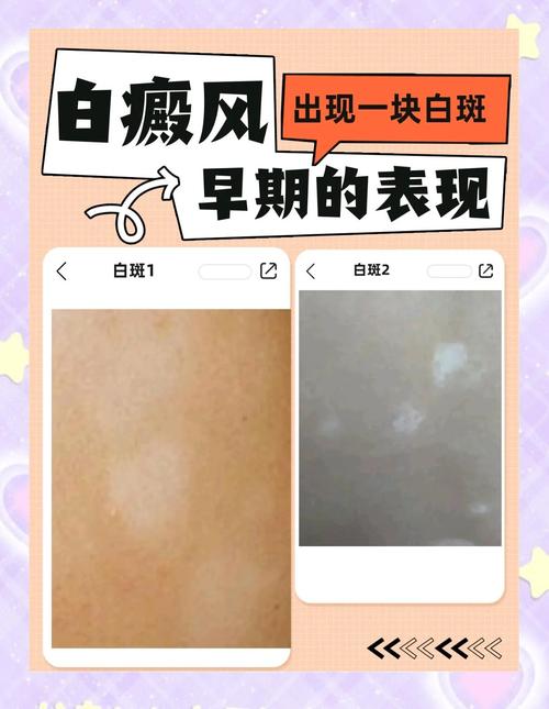 皮肤白一块黑一块是何原因?