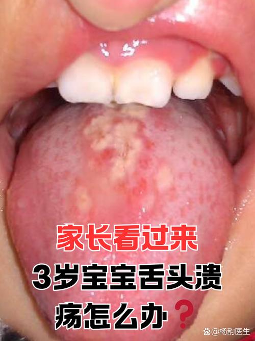 2岁宝宝长口腔溃疡正常吗?
