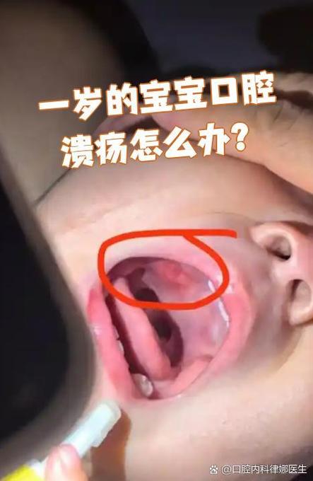 2岁宝宝长口腔溃疡正常吗?