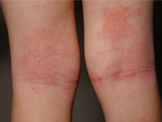 膝盖以下皮肤痒是怎么回事