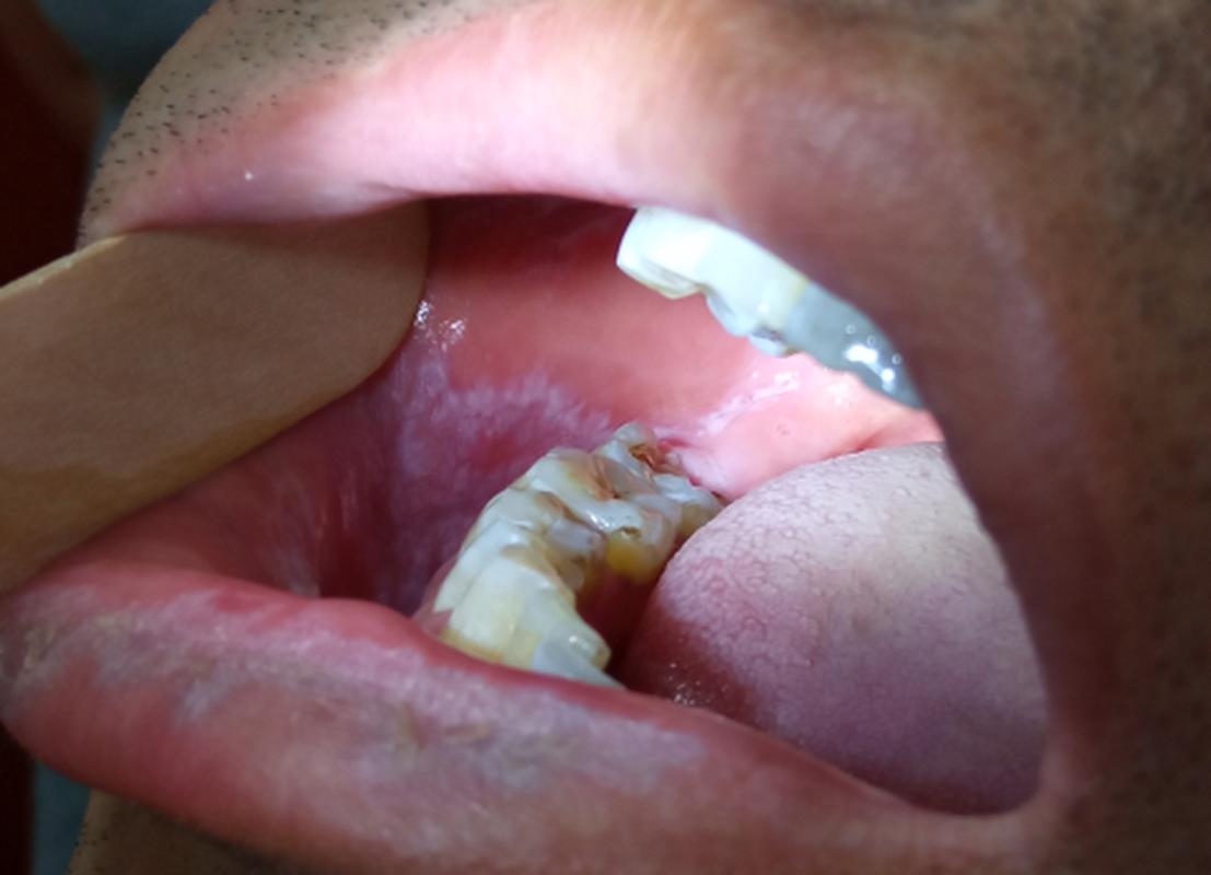 口腔壁白色黏膜是何问题?