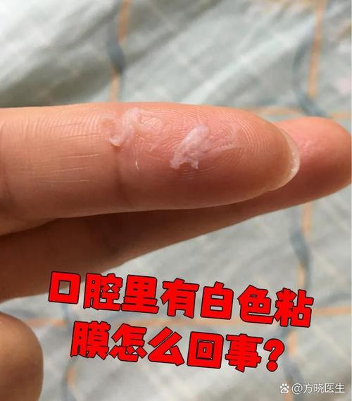 口腔壁白色黏膜是何问题?