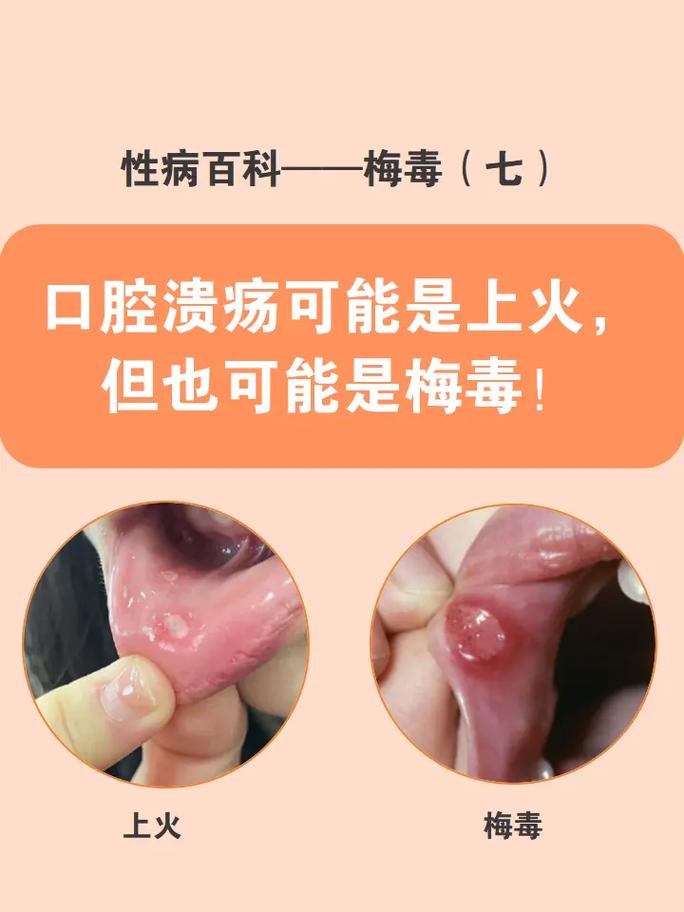 口腔溃疡一月一次正常吗?