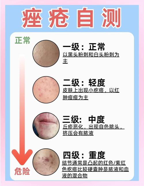 痤疮多久能恢复成正常皮肤