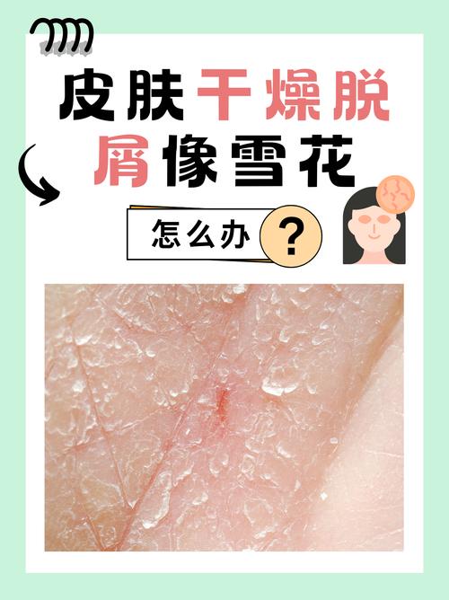 全身皮肤干燥掉皮屑,如何快速缓解?