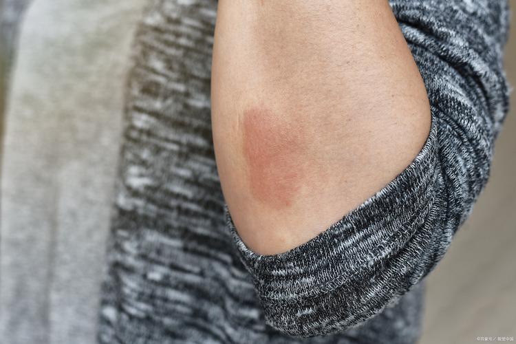 冬天皮肤痒,是缺水还是疾病?