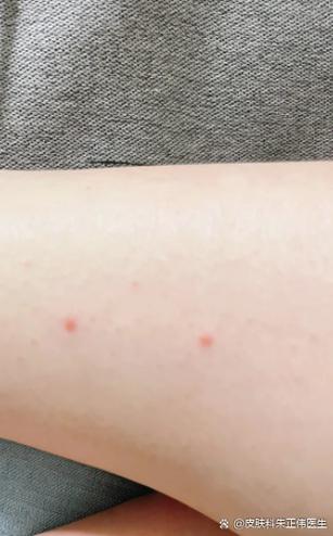 皮肤小红点不痛不痒是何原因?