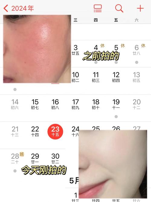 皮肤被太阳晒伤了怎么办