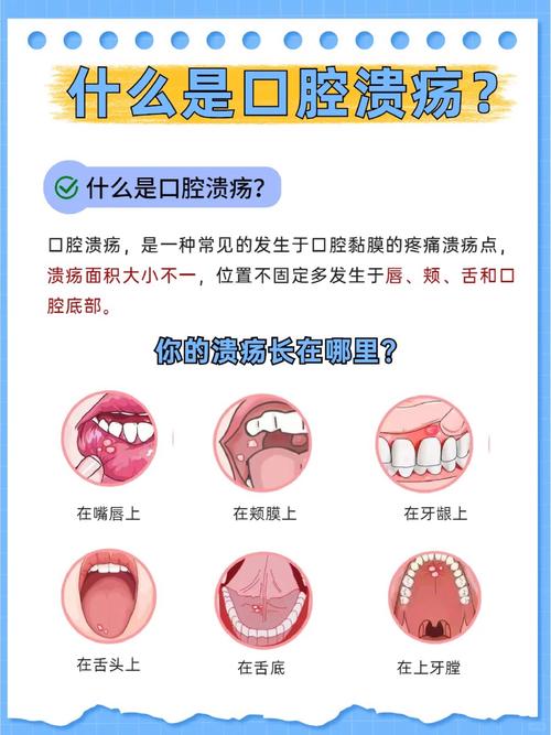 一岁半宝宝口腔溃疡,怎么办?