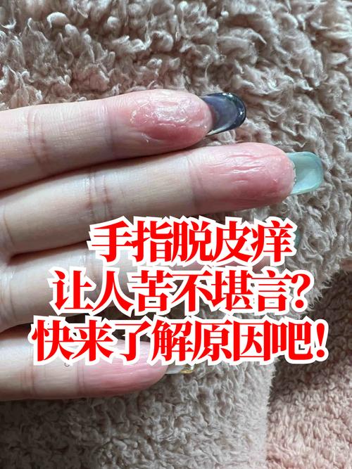 手部干燥粗糙,如何快速恢复细腻?