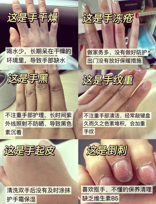 手部干燥粗糙,如何快速恢复细腻?