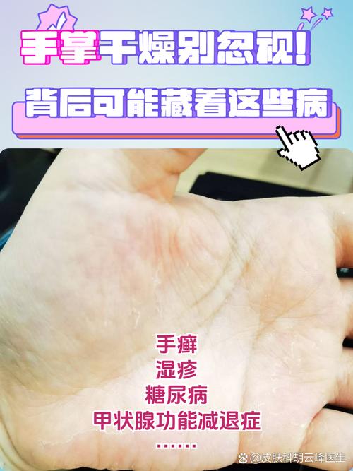 手部干燥粗糙,如何快速恢复细腻?