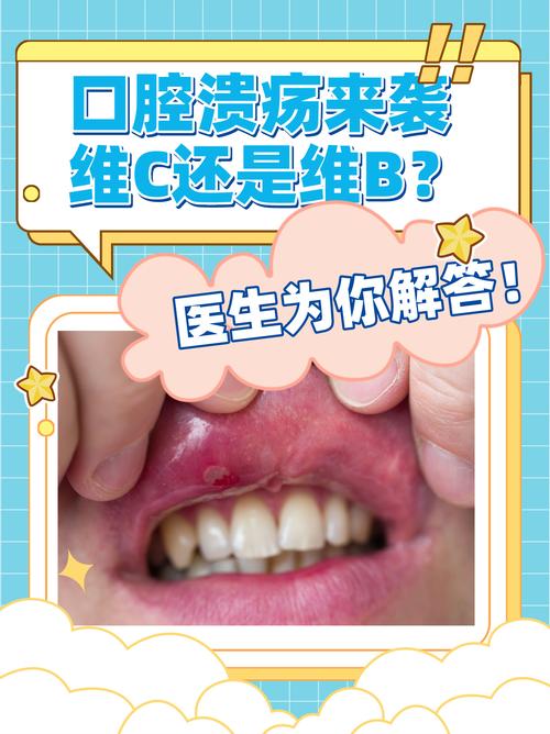 口腔溃疡吃维生素C真有用吗?