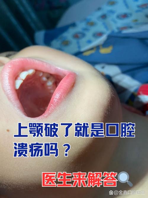 口腔上颚粘膜烂了怎么办?