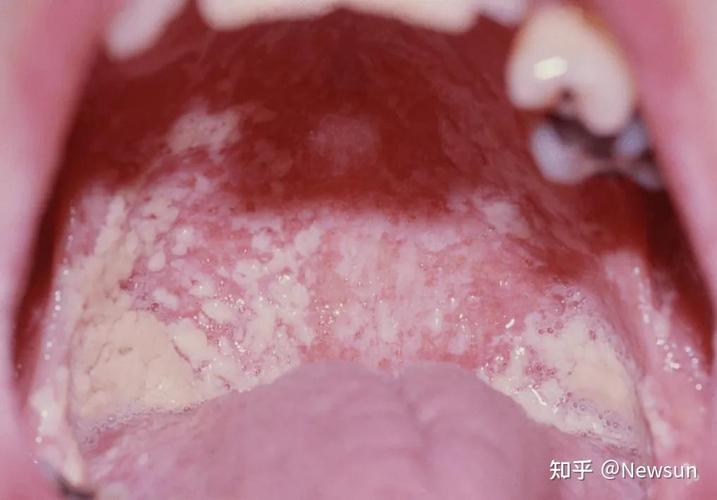 艾滋多久会口腔白念珠菌