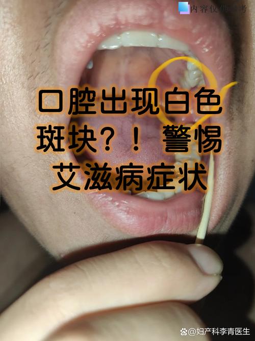 艾滋多久会口腔白念珠菌