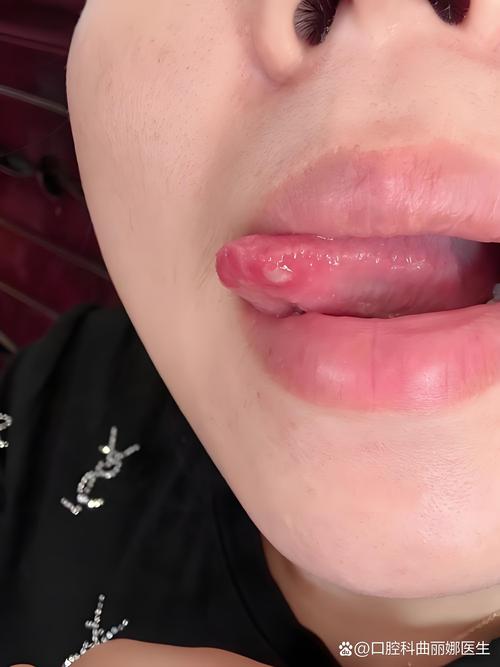 嘴巴咬破为何总成口腔溃疡?