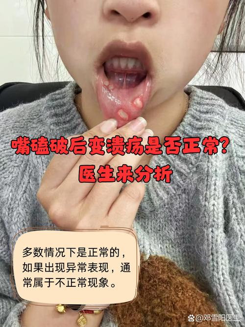 嘴巴咬破为何总成口腔溃疡?