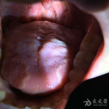 口腔尖锐会被误诊为咽炎吗?