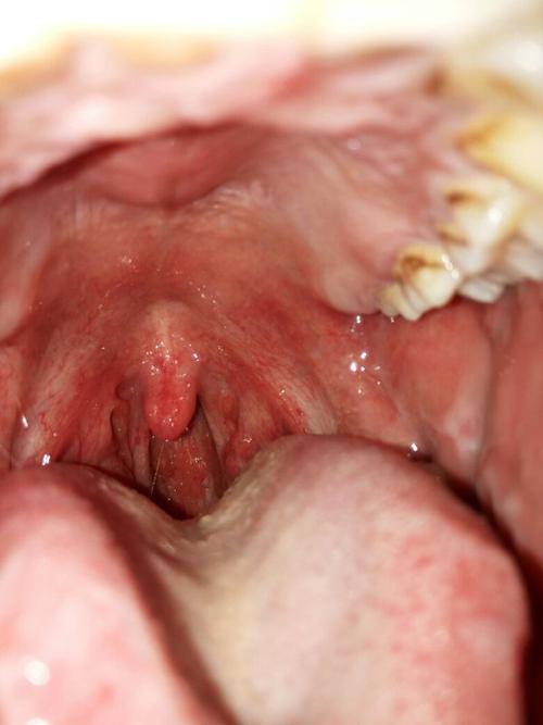 口腔上颚红色软包是啥问题?