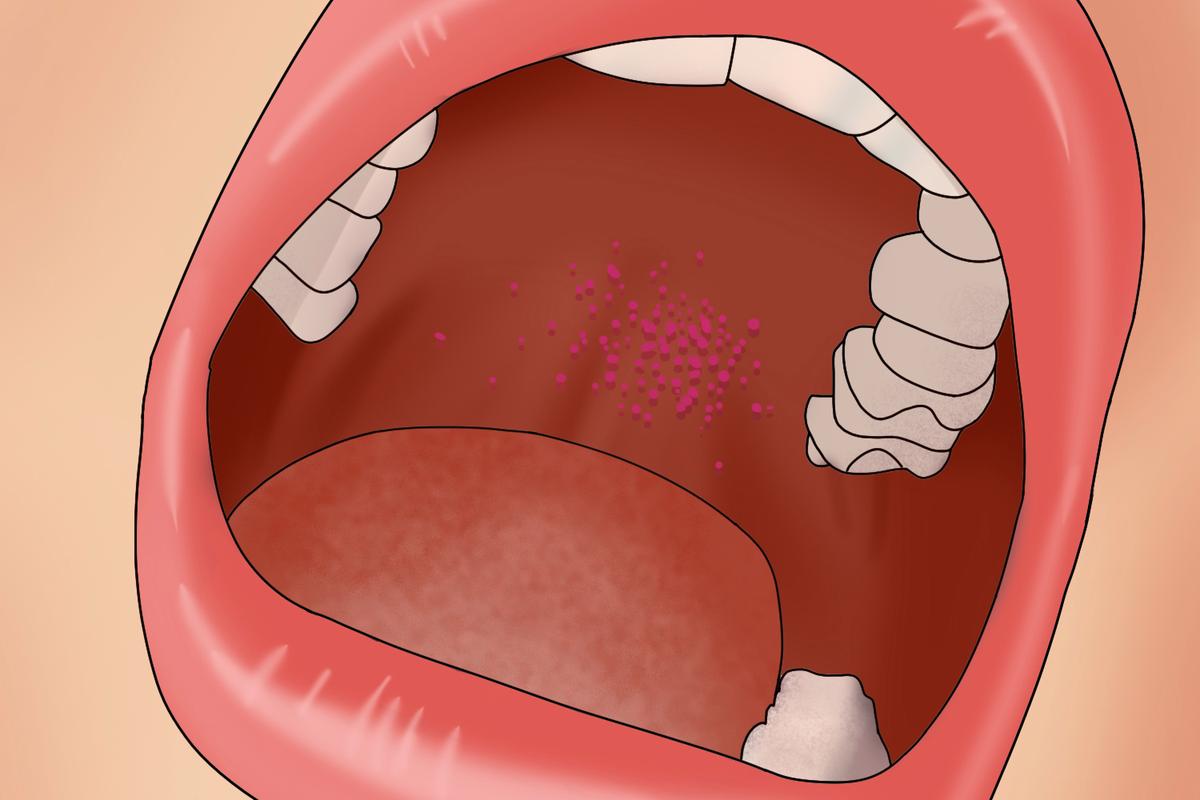 口腔上颚红色软包是啥问题?