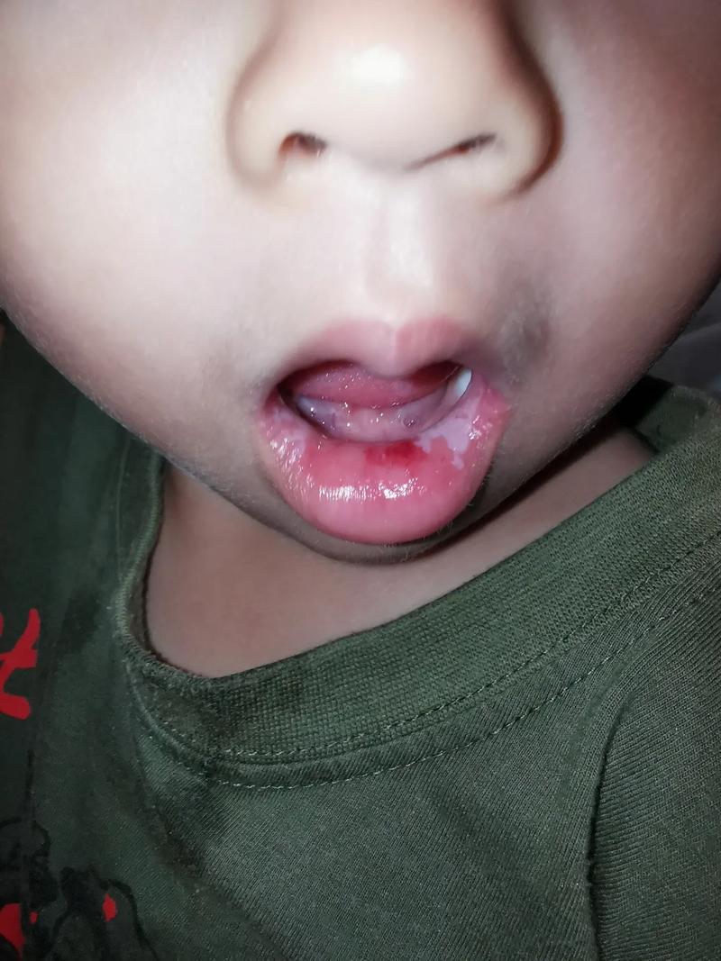 两个月宝宝口腔溃疡图片怎么回事?