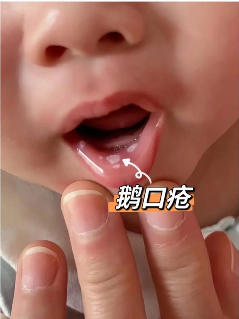 两个月宝宝口腔溃疡图片怎么回事?