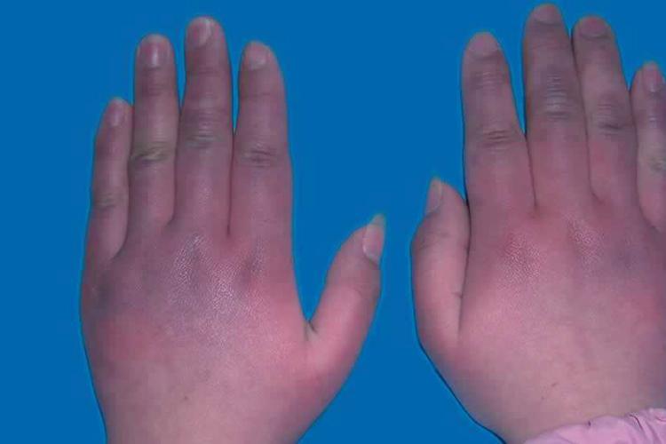 新冠感染后,皮肤会出现哪些症状?