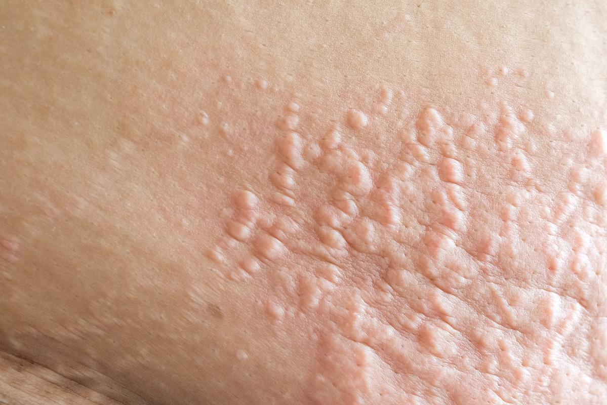 新冠感染后,皮肤会出现哪些症状?