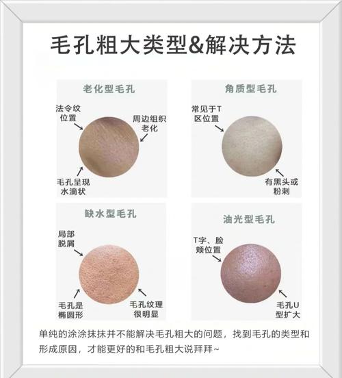 毛孔粗大怎么改善?
