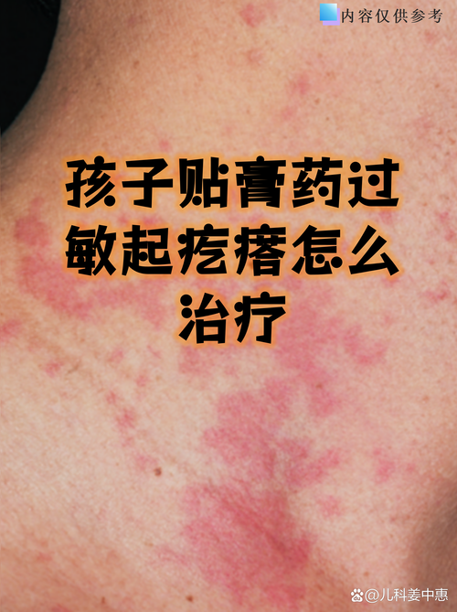 贴膏药过敏了,皮肤红肿痒怎么办?