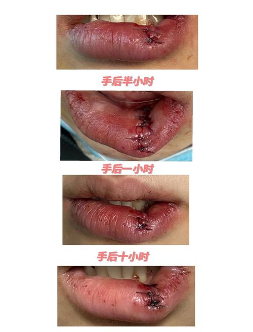 口腔囊肿术后恢复期要多久?